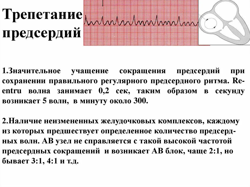 Трепетание предсердий 2:1. Атипичная трепетание предсердий. Трепетание предсердий 1 к 1 на ЭКГ. Трепетание предсердий характеризуется. Формы трепетания предсердий