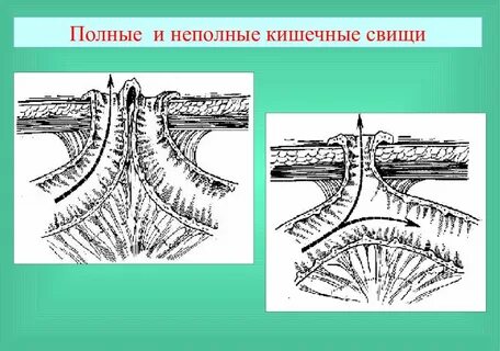 Кишечный свищ