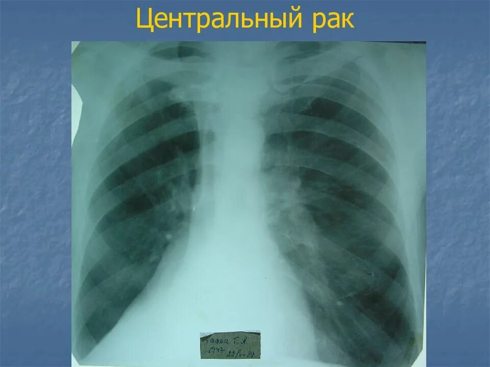 Центральный рак правого. Онкология правого легкого. Центральный CR правого легкого. Центральная карцинома легкого. Центральная карцинома левого легкого.