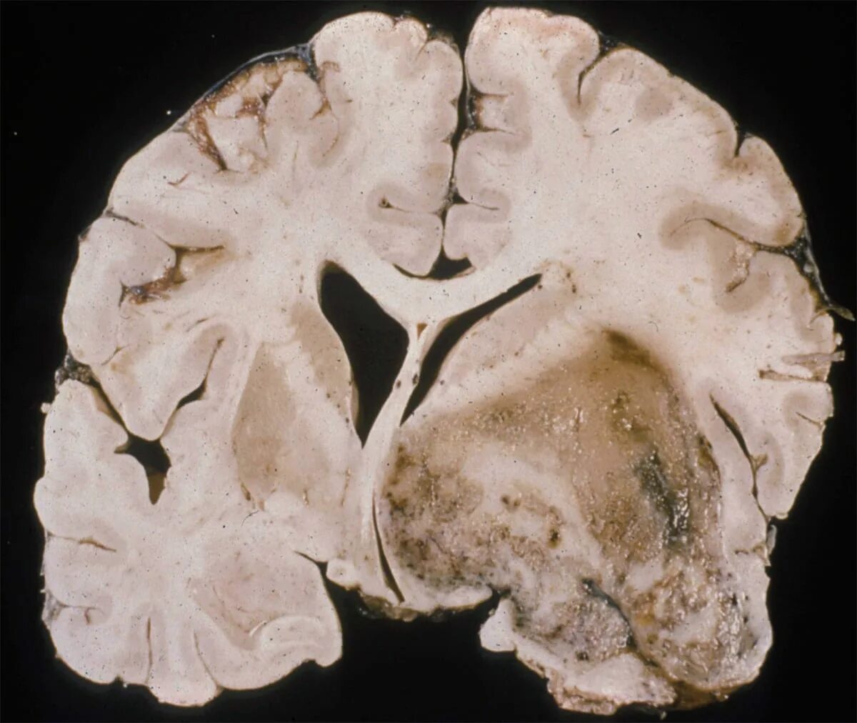 Отек мозга 3. Опухоль мозга глиобластома. Опухоль головного мозга макропрепарат. Миобластома головного мозга. Онкология глиобластома.