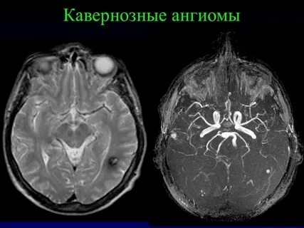 Кавернозная венозная мальформация
