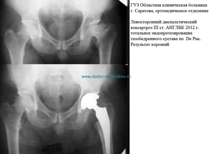 Перекос тазобедренного сустава. Искривления таза после эндопротезирования тазобедренного сустава. коксартроз эндопротезирование тазобедренного сустава. перекос таза после эндопротезирования тазобедренного сустава. тотальное эндопротезирование тазобедренного сустава.