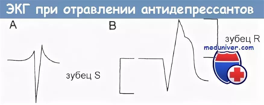 Отравление антидепрессантами. ЭКГ при отравлении трициклическими антидепрессантами. ЭКГ при отравлении антидепрессантами. Передозировка трициклическими антидепрессантами на ЭКГ. Изменения на ЭКГ при отравлении амитриптиллином.