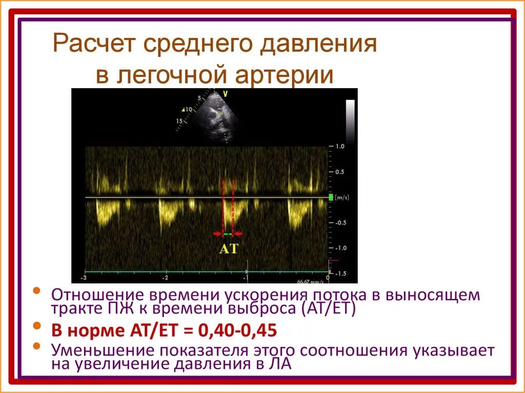 Эхо кг давление в легочной артерии норма. Измерение давления в легочной артерии при ЭХОКГ. УЗИ сердца давление в легочной артерии норма. Градиент давления на легочной артерии в норме. Легочная гипертензия сдла