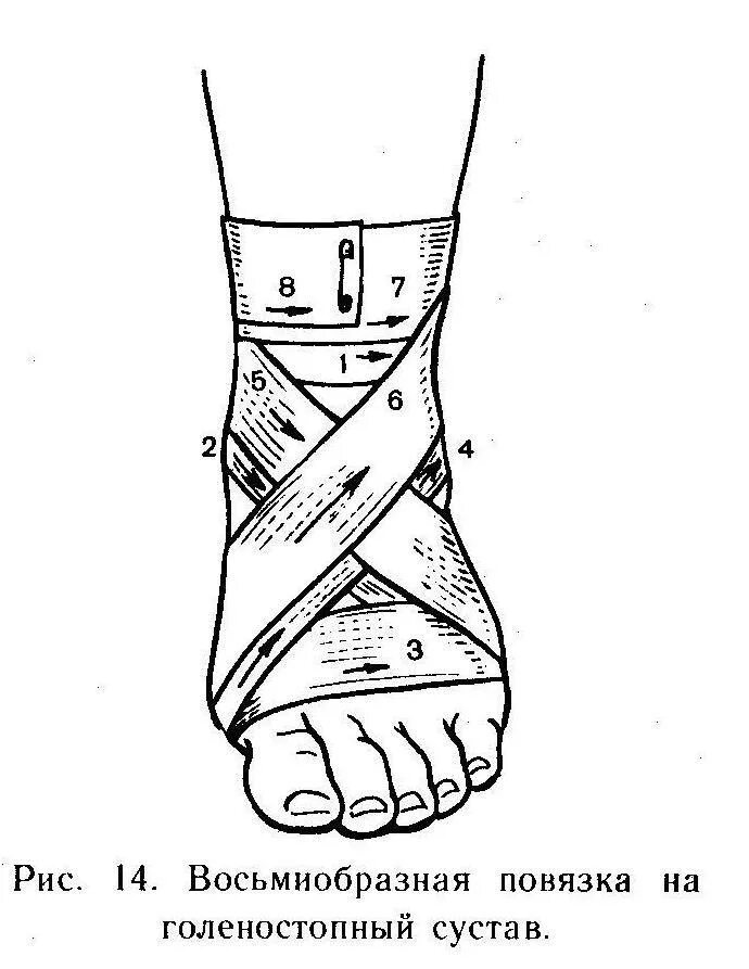 8 на голеностопный сустав. Восьмиобразная повязка на голеностопный сустав алгоритм. Восьмиобразная на голеностопный сустав алгоритм. Наложение восьмиобразной повязки на голеностопный сустав. Десмургия повязка восьмиобразная на голеностопный сустав.