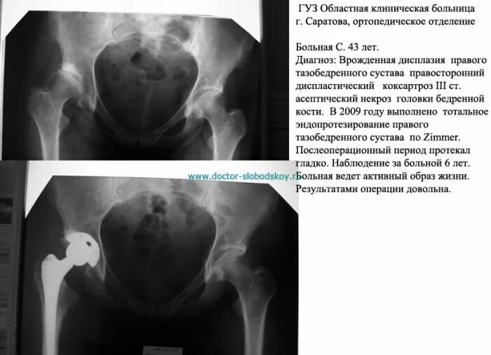 Некроз тазобедренного сустава лечение без операции. Асептический некроз шейки. асептический некроз шейки бедра. диспластический коксартроз головки бедренной кости. асептический некроз головки бедра рентген.