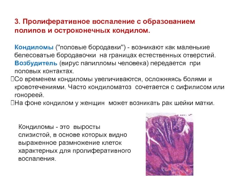 Остроконечные кондиломы патанатомия. Пролиферативное воспаление с образованием остроконечных кондилом. Пролетеравианое воспаления. Пролиферативное воспаление. Почему появляются воспаления