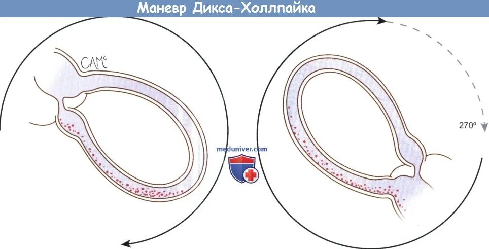 Проба холпайка. Манёвр Дикса-Халлпайка. Проба Дикса-Холпайка. Отокония. Позиционная проба Дикса-Холлпайка.