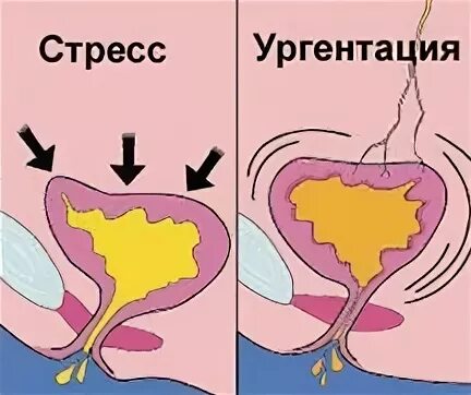 Недержание мочи у женщин. Мочевой пузырь недержание. Ургентное недержание мочи. Стрессовое недержание мочи у женщин.