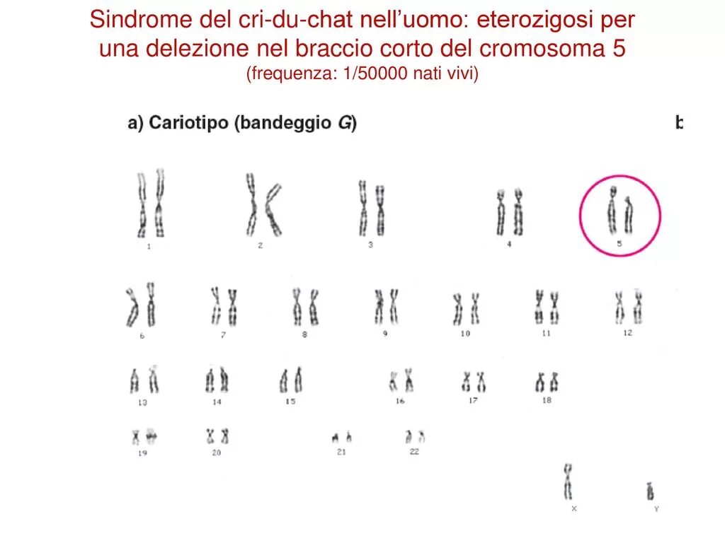 Кариограмма при синдроме кошачьего крика. Синдром кошачьего крика кариотип. Кариотип при синдроме кошачьего крика. Формула кариотипа при синдроме кошачьего крика. Мужская хромосома 5