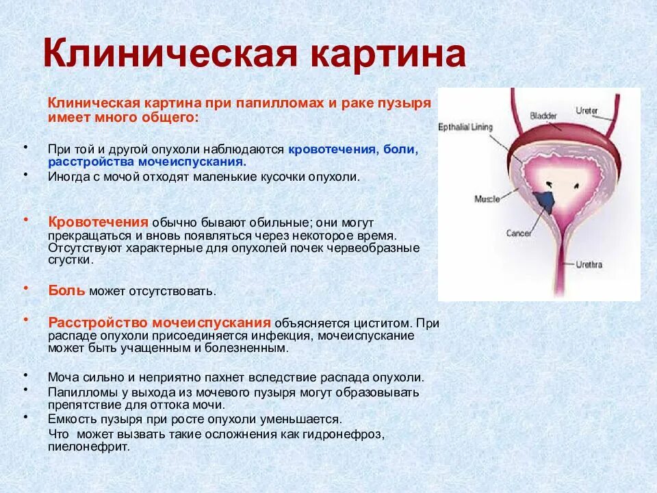 Лечение рака мочевого пузыря у мужчин. Опухоль мочевого пузыря. Опухоль мочевого пузыря у женщин. Клинические проявления опухоли мочевого пузыря. Опухоль мочевого пузыря клиника.