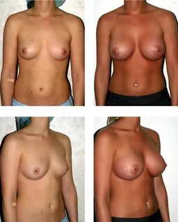 File:Dr. Placik Breast Augmentation .jpg - Wikipedia.