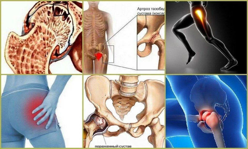 Тазобедренная боль у женщин причины и лечение. Коксартроз тазобедренного сустава симптомы. Коксартроз (артроз тазобедренного сустава). Коксалгия тазобедренного сустава. Остеоартроз коксартроз тазобедренного сустава.