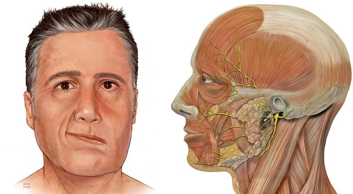 Парез лицевого нерва и тройничного. Неврит лицевого нерва. Отогенный неврит лицевого нерва. Периферический неврит лицевого нерва. Левый лицевой нерв