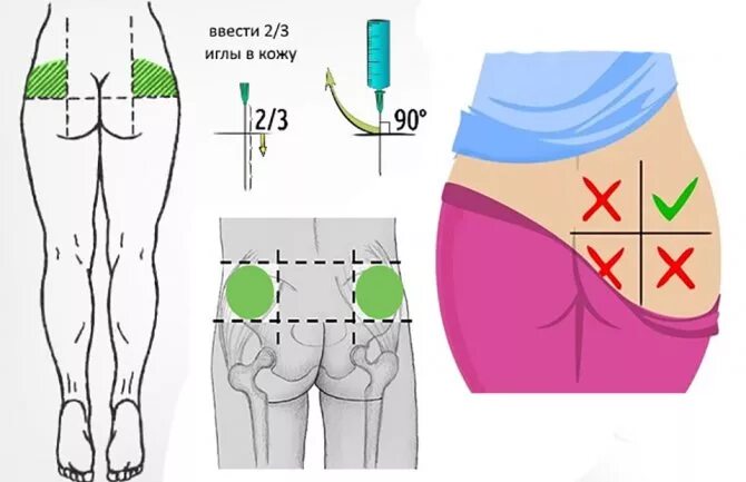 Болят ягодицы от уколов. Схема как колоть уколы в ягодицу. Как правильно делать уколы внутримышечно в ягодицу. Как правильно колоть укол внутримышечно в ягодицу взрослым. Как правильно научиться делать уколы в домашних условиях в ягодицу.