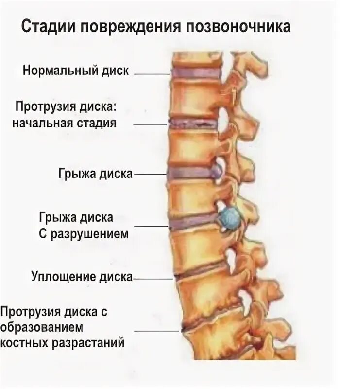 Грыжи и протрузии позвоночника. Стадии развития грыжи межпозвоночного диска. Позвоночник - протрузия и грыжа диска. Грыжа дисков позвоночника что это такое.