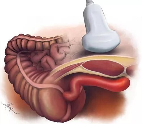 Аппендицит исследования. УЗИ аппендикс аппендикс. УЗИ аппендицита (аппендикса). УЗИ червеобразного отростка. Подпеченочный аппендицит УЗИ.