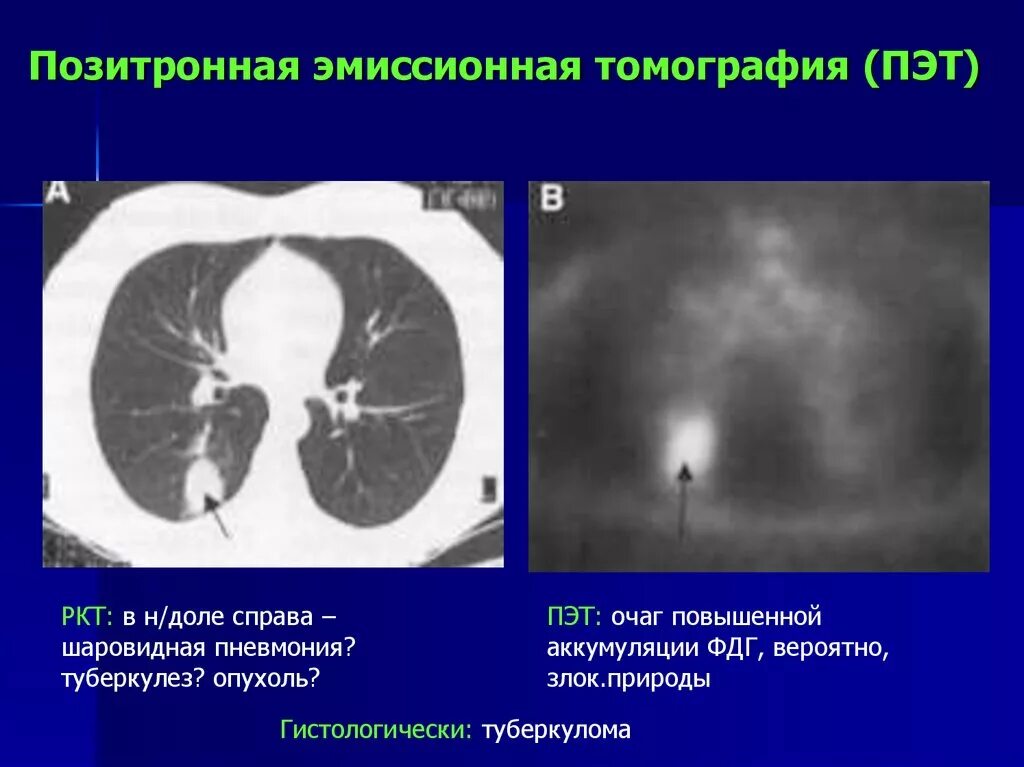 ПЭТ томография. Шаровидная пневмония на кт. Шаровидные образования легких кт. Лучевая пневмония ПЭТ кт.