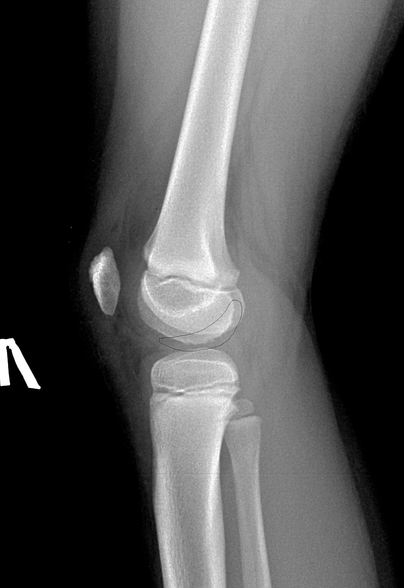 Коленные суставы 9 лет рентген. Рентгенограмма коленного сустава ребенка. Коленный сустав рентген норма. Надколенник рентген в 4 года. Колена 21 год