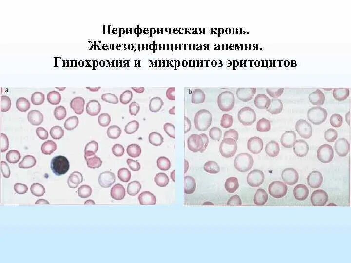 Гипохромия железодефицитная анемия. Гипохромия и гиперхромия. Микроцитоз анемия. Гипохромия микроцитоз. Микроцитоз и гипохромия без анемии.