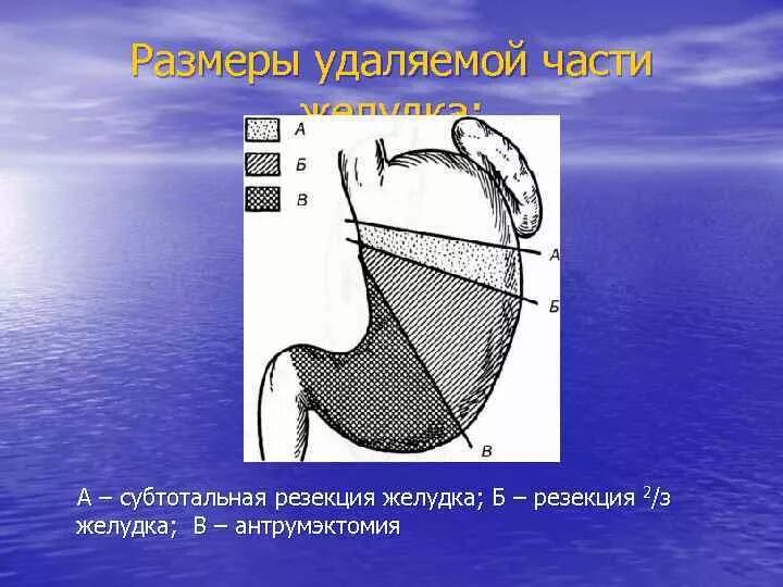 После удаления части желудка. Резекция части желудка. Дистальная субтотальная резекция желудка. Размеры удаляемой части желудка. Проксимальная субтотальная резекция желудка.