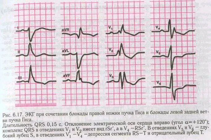 Блокада левой ножки пучка гиса на экг. ЭОС при неполной блокаде правой ножки пучка Гиса. Блокада правой ножки пучка зубец р. Отклонение оси влево на ЭКГ угол. Зубец s при блокаде правой ножки пучка Гиса.