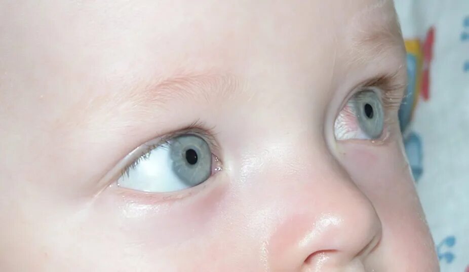 Глазки в 4 месяца. Герпетический кератит у детей. Глаза новорожденного.