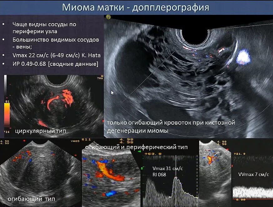 Миома матки допплерография. Размеры миоматозного узла. Цветовое допплеровское картирование миома матки.