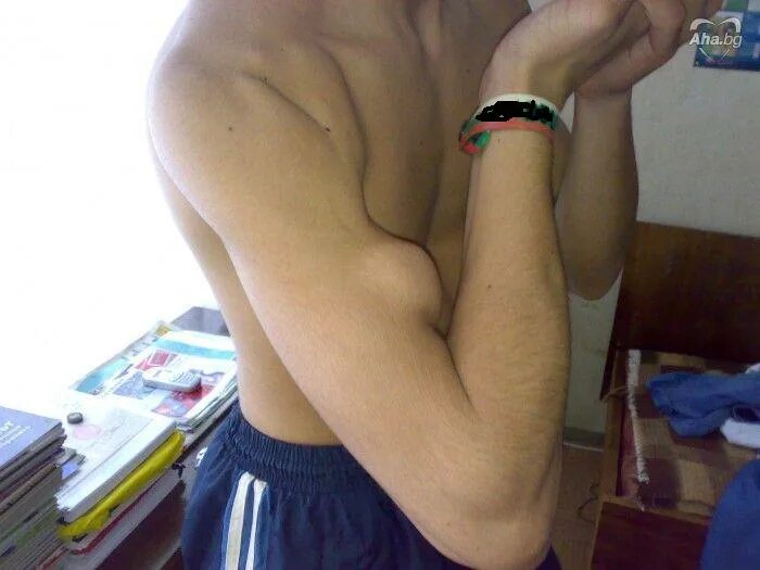 малый бицепс. рука без бицепса. маленький бицепс. арнольд шварценеггер в молодости бицепс. сильные руки.