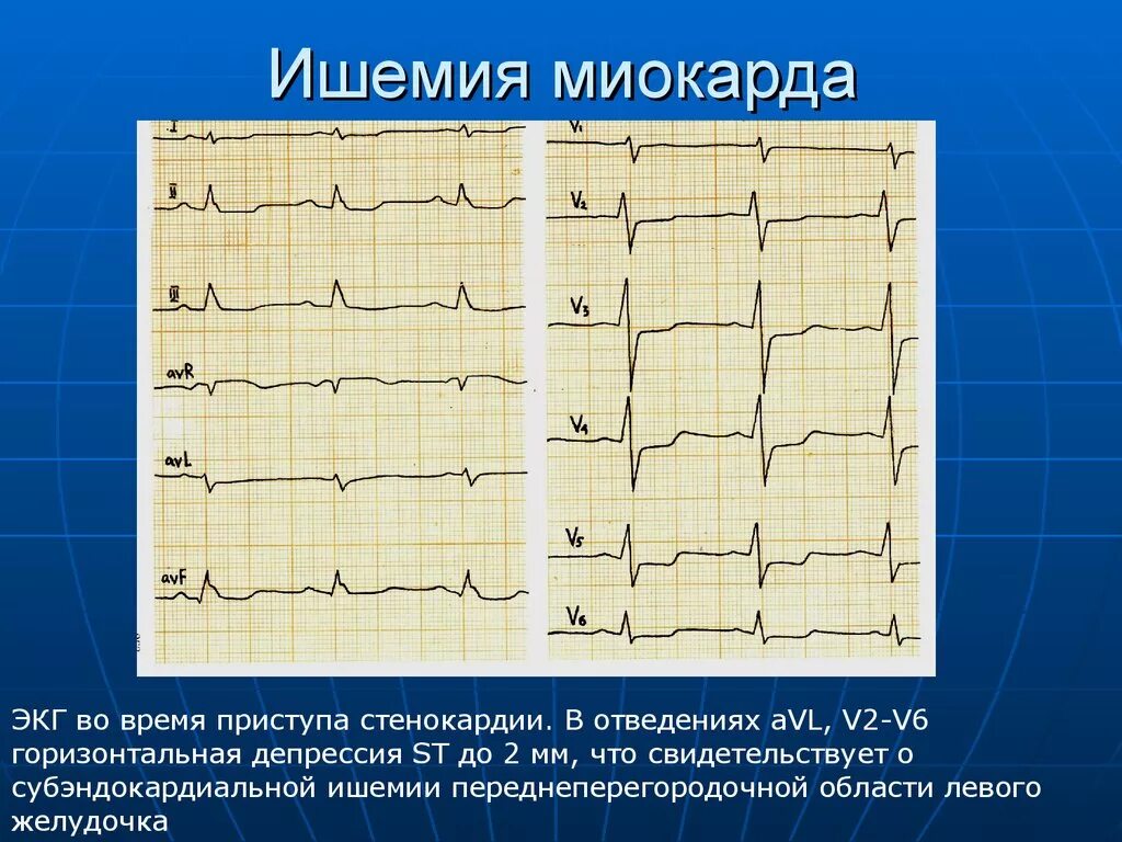 Изменения миокарда предсердий. Изменения на ЭКГ при ишемии миокарда. Признаки ишемии миокарда на ЭКГ. Изменения на ЭКГ, характерные для ишемии миокарда. Субэндокардиальная ишемия на ЭКГ.