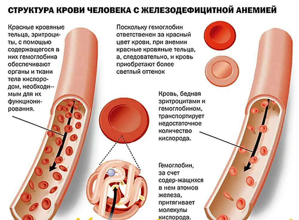 Диагностика и лечение В12-дефицитной анемии: Иллюстрации Рамка реальности 27soko