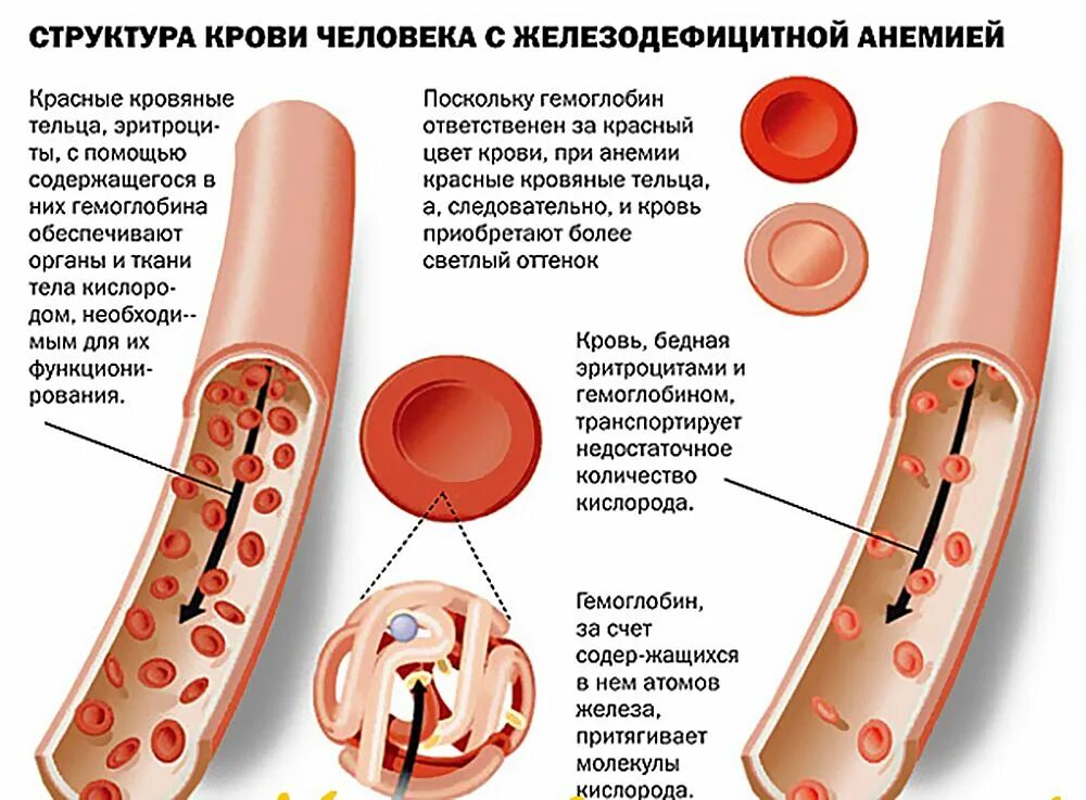 Причины анемии крови. Структура крови человека с железодефицитной анемией. Железо крови при железодефицитной анемии. Железодефицитная анемия симптомы. Железодефицитная анемия картинки.