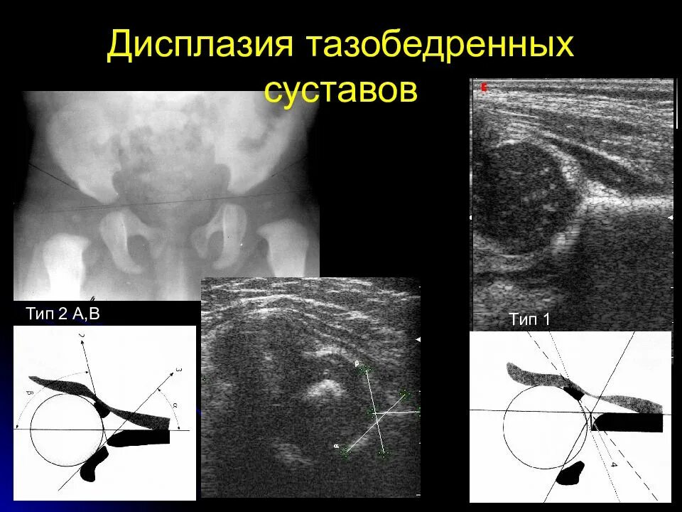 Наличия дисплазии. Дисплазия тазобедренных суставов у детей на УЗИ. УЗИ тазобедренного сустава у детей методика. Дисплазия тазобедренных суставов у новорожденных УЗИ.