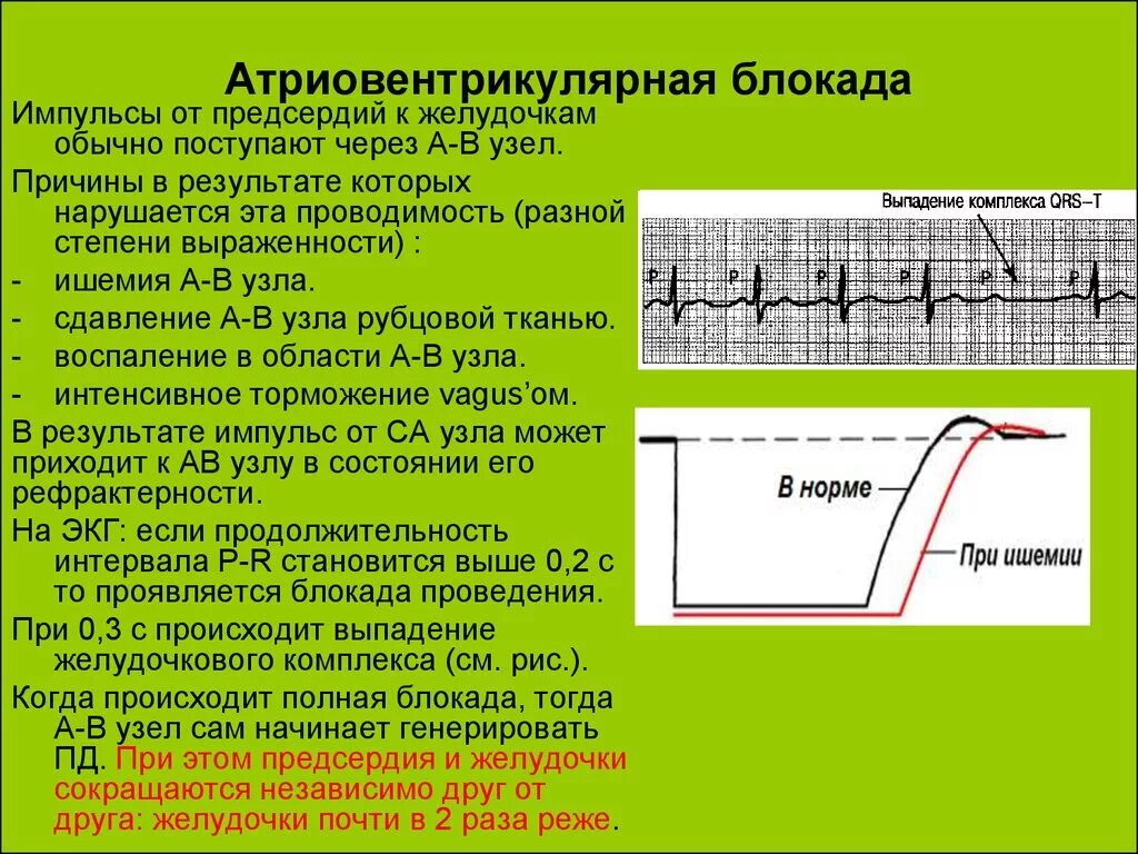 Полная атриовентрикулярная блокада. Основные ЭКГ признаки АV блокады. Клинические признаки атриовентрикулярной блокады. При полной атриовентрикулярной блокаде (3 степени) наблюдается:. Признаки атриовентрикулярной блокады III степени.