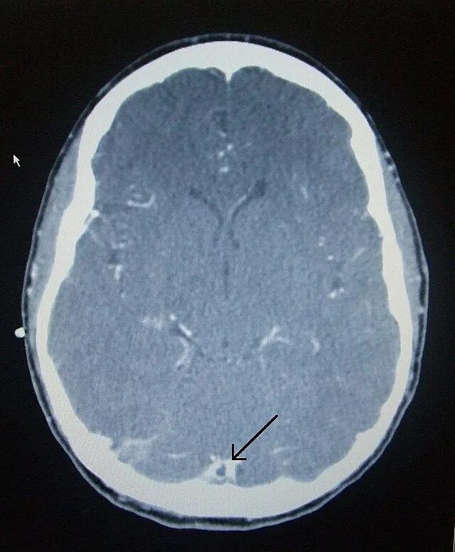 Тромбоз поперечного синуса кт. Тромбоз синусов головного мозга кт. Тромбоз поперечного синуса головного мозга на кт. Тромбоз венозного синуса головного мозга кт. Тромбоз на кт