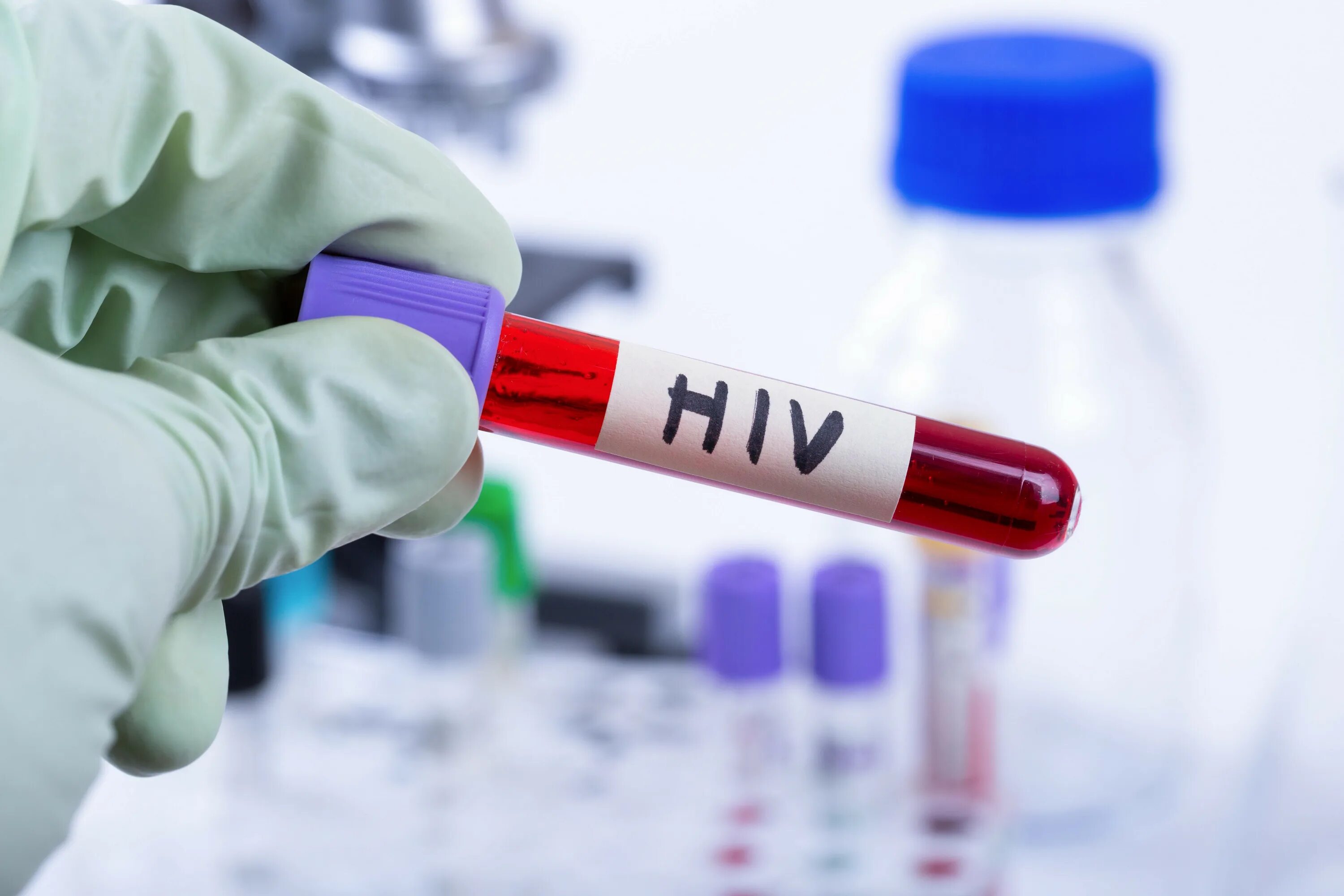 Исследование на ВИЧ. Исследование крови на ВИЧ картинками. СПИД пробирка.