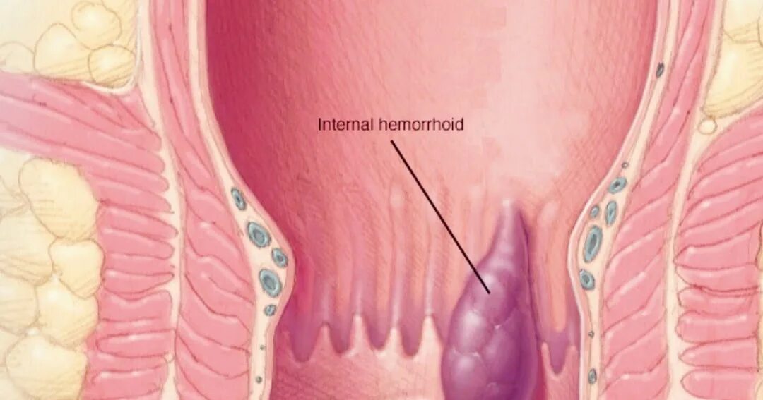 Внутренние геморроидальные узлы. Трещина в заднем проходе кровоточит