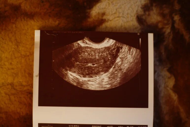 Снимки УЗИ на 3 неделе беременности. УЗИ 2-3 неделя беременности УЗИ. Снимок УЗИ беременности 1-2 недели. Снимок УЗИ на 2 неделе беременности.