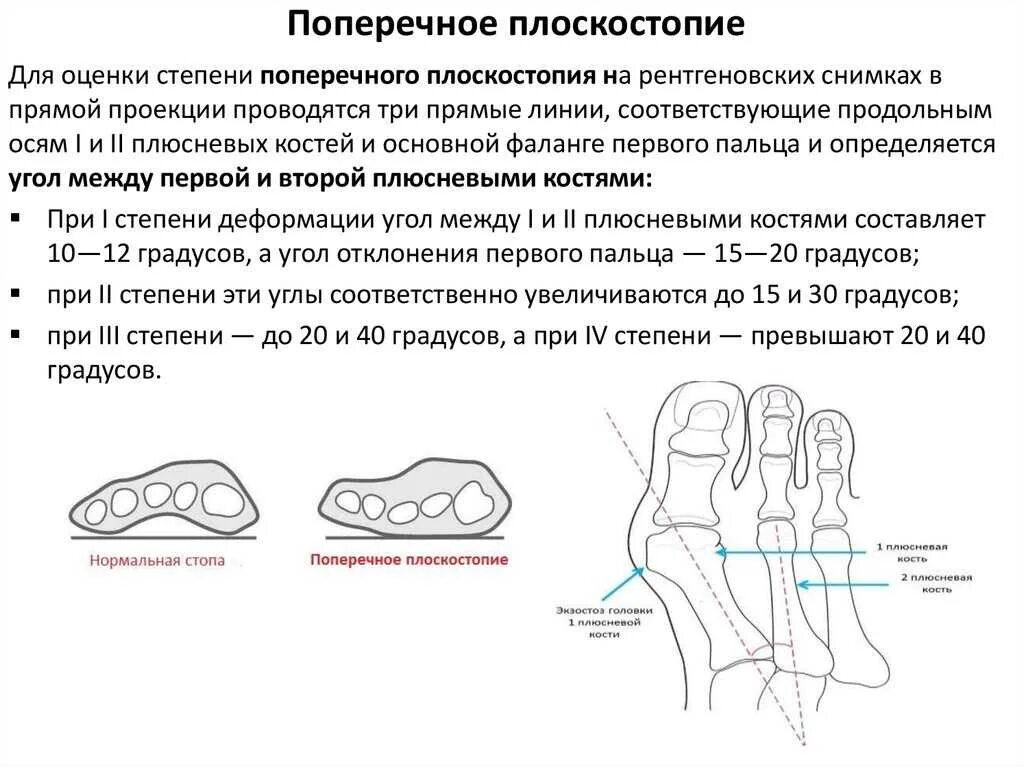 Мкб 10 плюсневая кость. Поперечное плоскостопие рентген. Степени плоскостопия на рентгене таблица. Продольно-поперечное плоскостопие 3 степени. Поперечное плоскостопие градусы рентген.