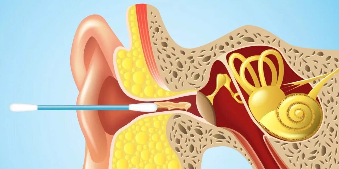 Clean ear. Серная пробка ватные палочки. Чистка ушей ватными палочками. Серная пробка на барабанной перепонке.