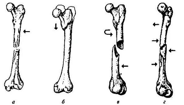 Укорочение трубчатых. Классификация переломов трубчатых костей. Переломы трубчатых костей. Поперечный перелом трубчатой кости. Продольный перелом трубчатой кости.