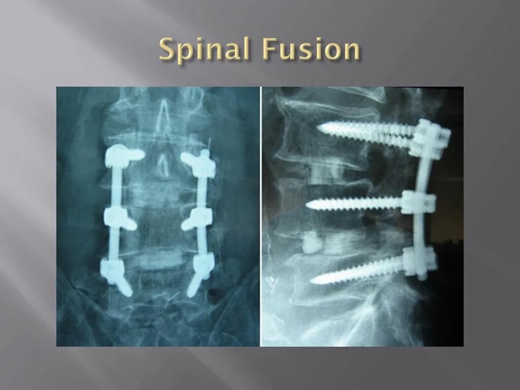 Операция на позвоночник сколько времени. Межтеловой Кейдж. Спондилодез поясничного отдела позвоночника рентген. Остеосинтез позвоночника l1 транспедикулярной. Межтеловой Кейдж рентген.