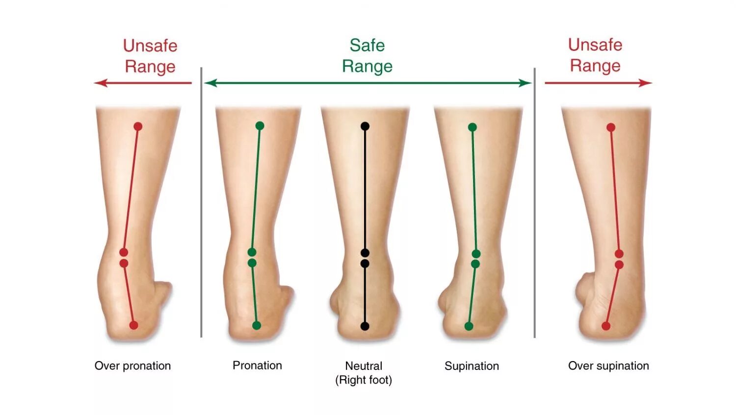 Пронация и супинация стопы. Плоскостопие пронация стопы. Гиперпронация стопы плоскостопие. Пронация вальгус стопы.