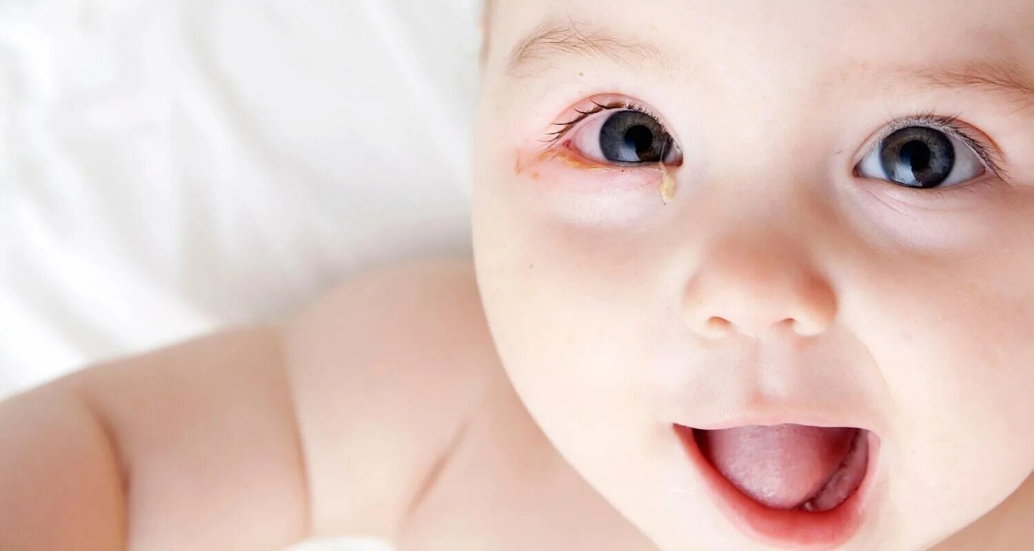 Baby eye песня. Конъюнктивит у новорожденных. Гонобленнореи новорожденного. Инфекция глаз у новорожденных детей. Гонобленнорея конъюнктивит.