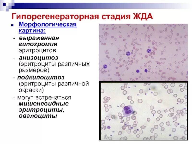 Гипохромия выраженная. Регенераторная гиперрегенераторная анемия.  гипохромия  микроциты  анизоцитоз  пойкилоцитоз. жда анизоцитоз пойкилоцитоз. морфологическую картину крови при железодефицитной анемии.