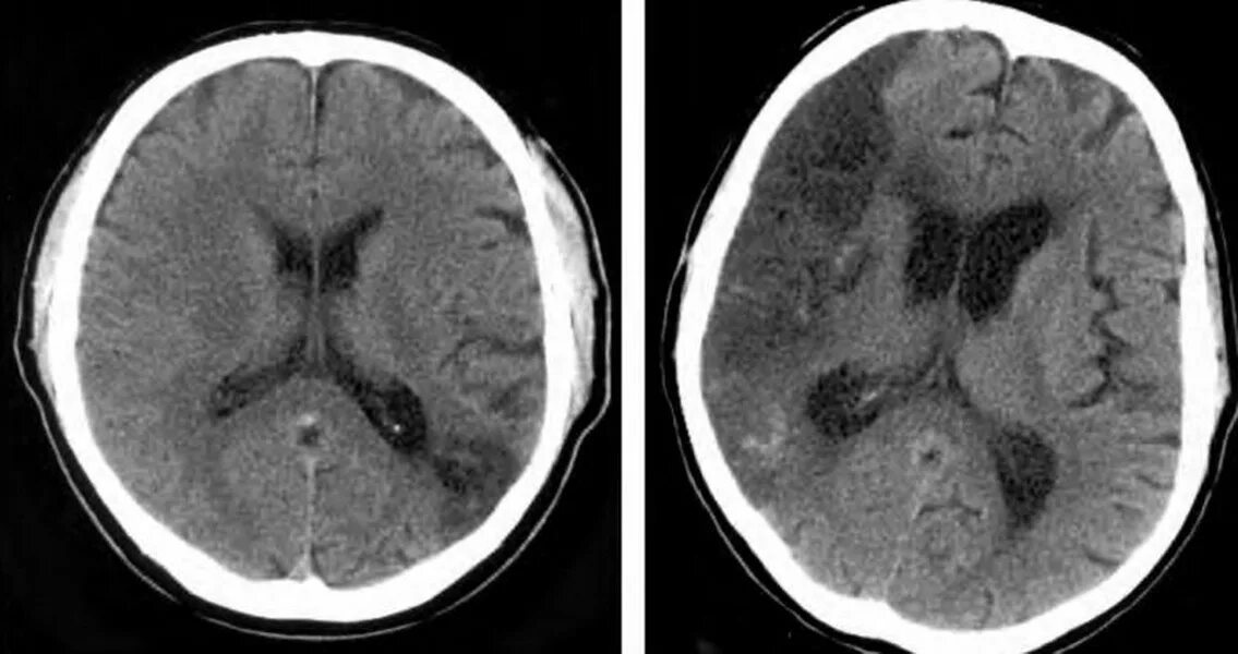 Очаги глиоза в головном мозге на кт. Сосудистые очаги глиоза в головном мозге что это. Очаг глиоза вещества мозга. Очаг периваскулярного глиоза. Единичное очаговое изменение дисциркуляторного характера