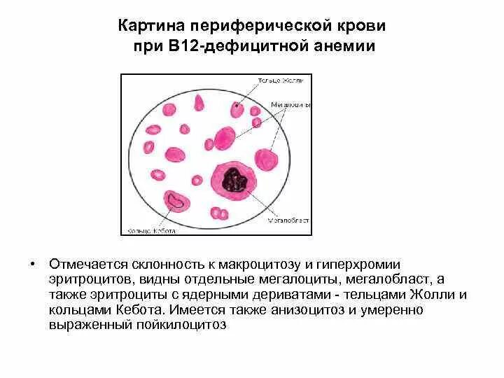 Синдром тельца. Картина периферической крови при в12 дефицитной анемии. В12 фолиеводефицитная анемия картина крови. Картина крови при в12-фолиеводефицитной анемии. Изменения показателей крови при в-12 дефицитной анемии.