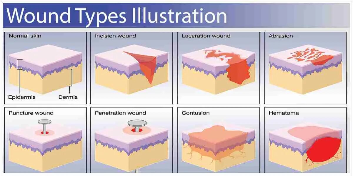 Types of wound. Types of wound