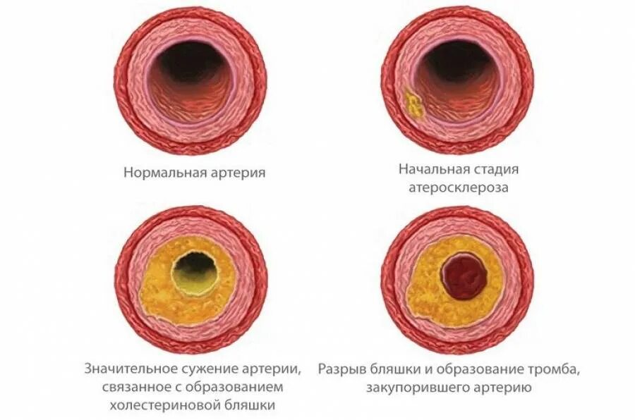 Атеросклеротические бляшки в сосудах образуются. Кальцинированная атеросклеротическая бляшка. Атеросклеротические бляшки формируются в. Атеросклероз холестериновая бляшка. Расширение стенок сосудов