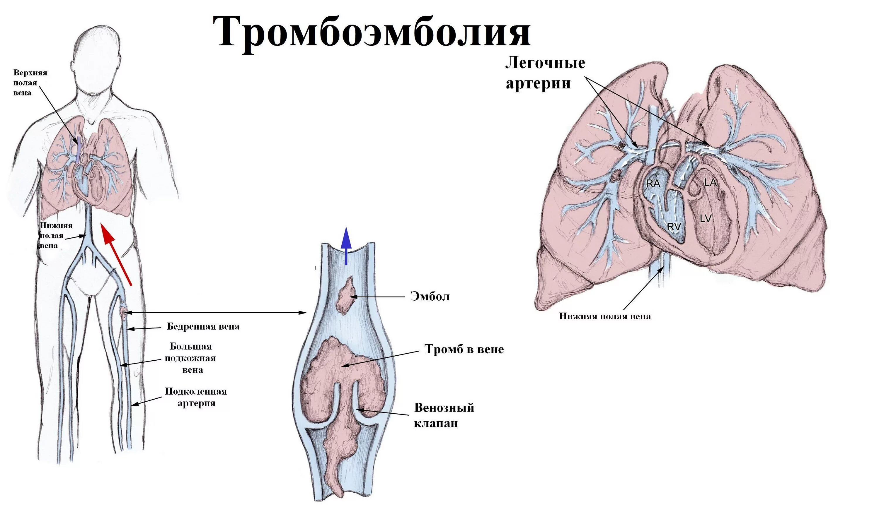 Тромбоэмболия ветвей легочной артерии. Тромбоэмболия легочной артерии (Тэла). Тромб легочной артерии тромбоэмболия. Эмболия тромбом легочной артерии. Тромболегочная эмболия